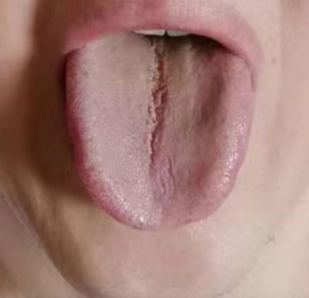 舌中间裂纹，舌苔泛黄，舌边鼓胀，像这样的舌象，调理一定要有分寸[绿帽子]
粉丝反