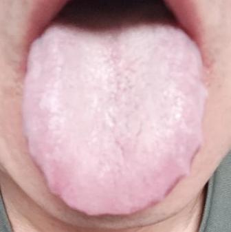 虽然白苔，阳虚，但也千万不能用桂附来补阳！一补就上火！
 
看舌头，白，还有厚腻