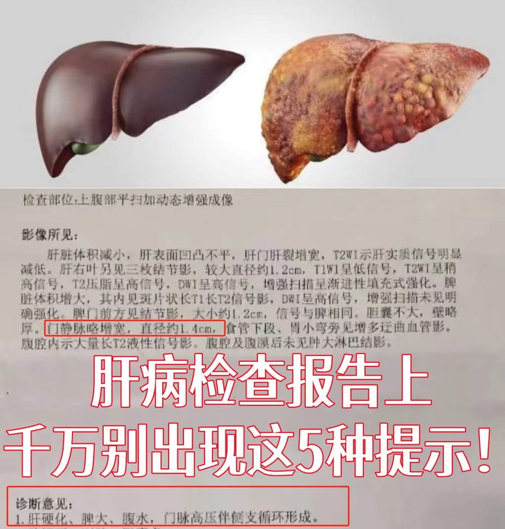 肝病检查报告上千万别出现这5种提示！ ①甲胎蛋白升高大于400，往往提...