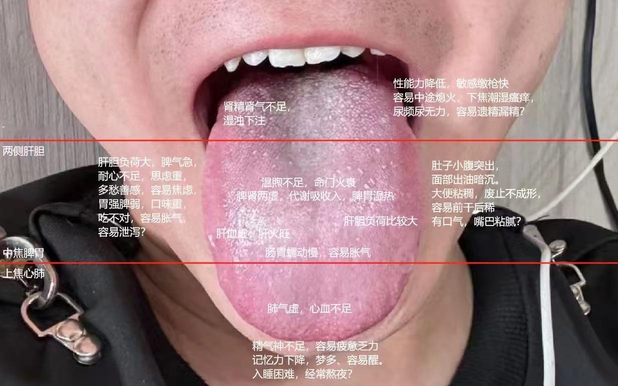 粉丝舌象分析，你拍舌象，现场分析！
今天出场的患者，舌根苔白腻，舌边鼓胀发红，潘