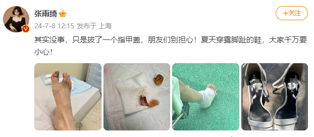 #张雨绮拔了一个脚指甲# 张雨绮拍戏时因为意外拔掉了一个脚指甲，想想都觉得疼！提