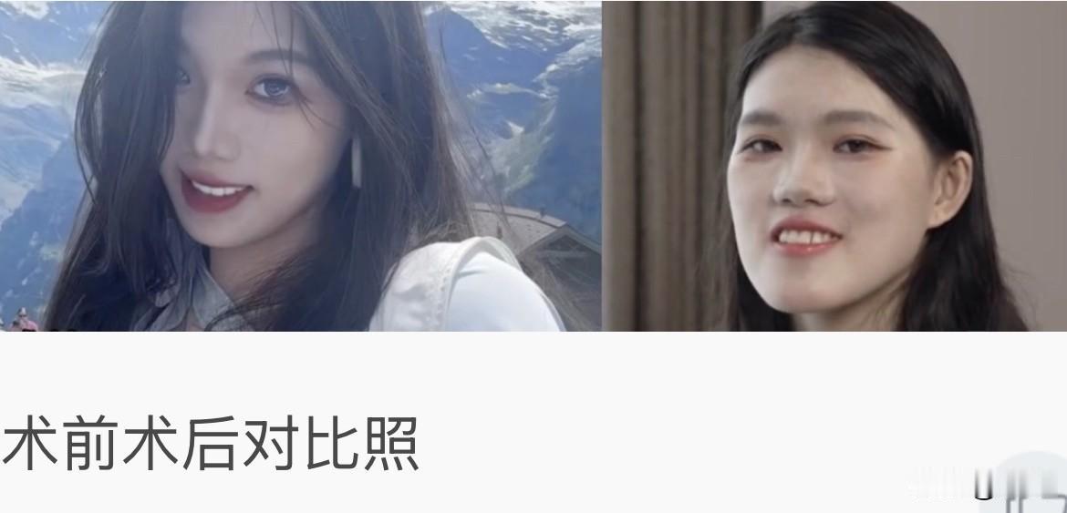 24岁武汉姑娘小雨，本来只是去武大口腔咨询补个牙。接诊医生一通检查，直接说：你得