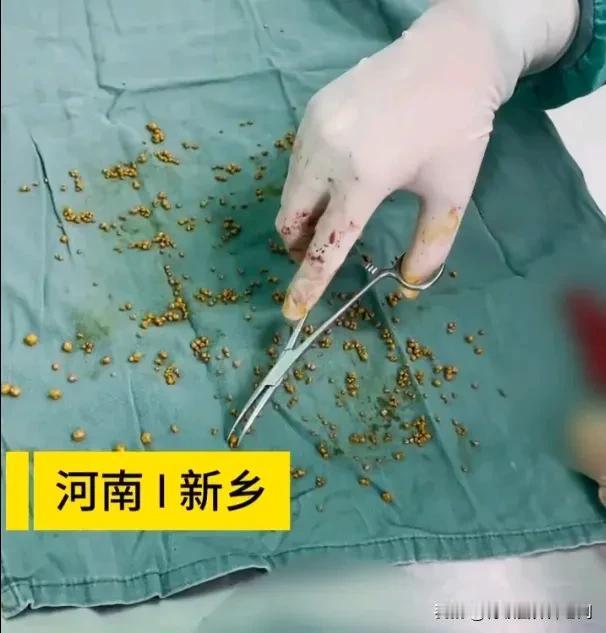 看见这几百个“小石头”没有，这是警告生活方式不健康、胡吃海喝的人该清醒了，不然迟