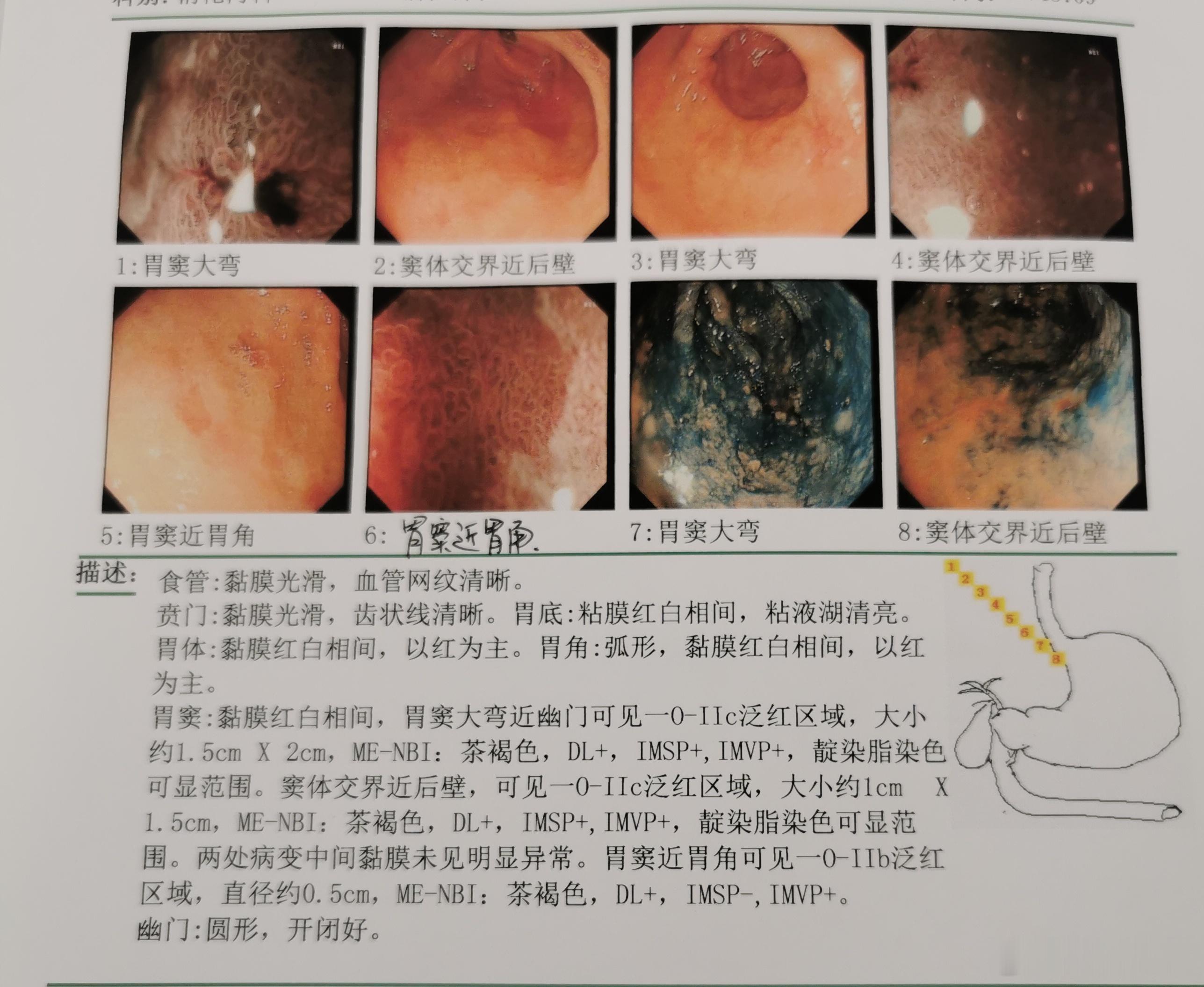 胃早癌核心是看边界DL，微结构MS、微血管MV。这类诊断也讲究概率，结合高龄、幽