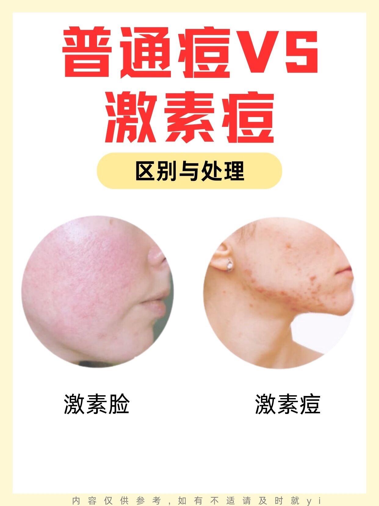 怎么区分激素痘还是普通痘?该怎么修复?痘痘痤疮长痘痘怎么办