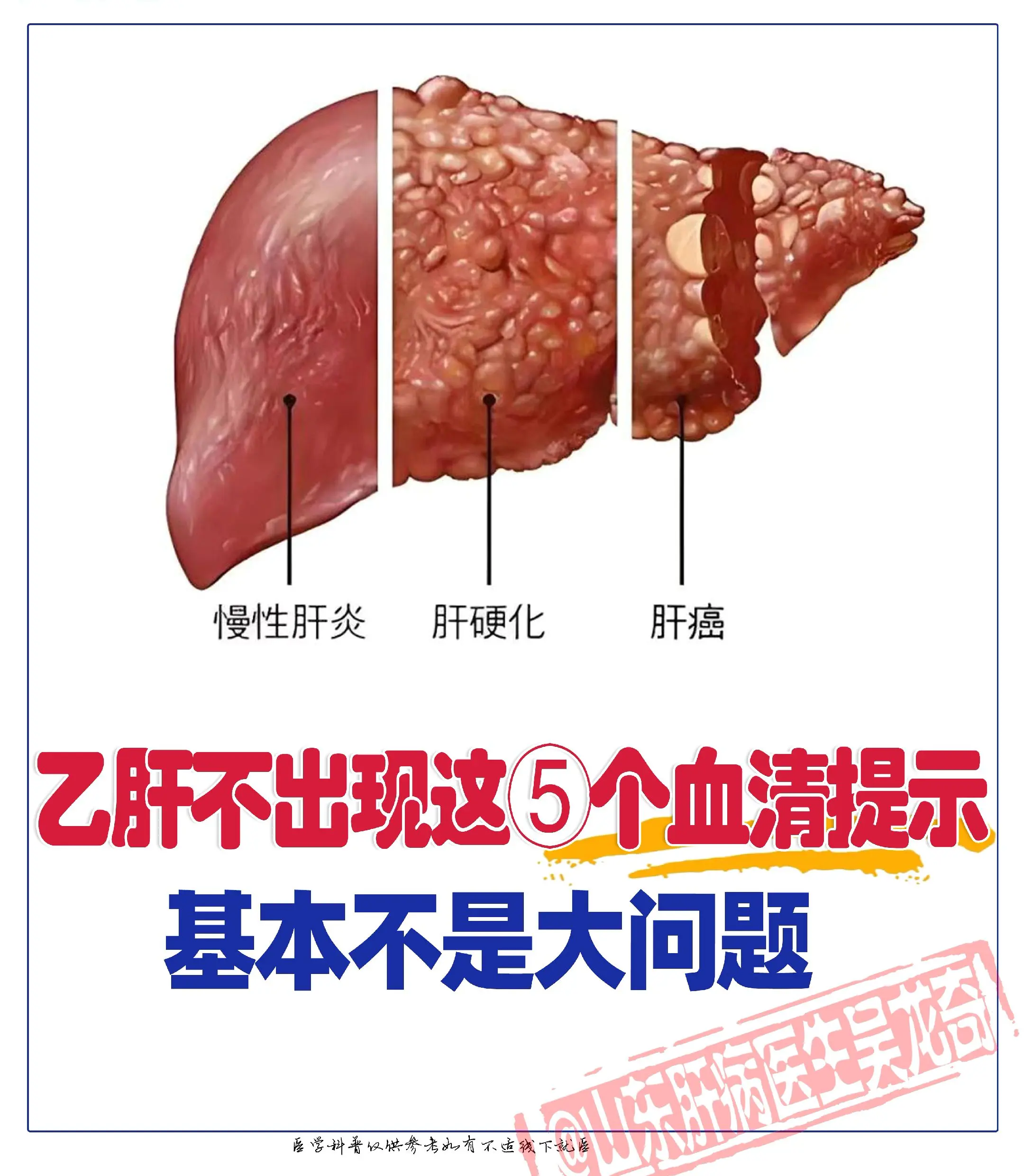 乙肝不出现，这⑤个提示，基本不是大问题 。①甲胎蛋白＞400:甲胎蛋白...