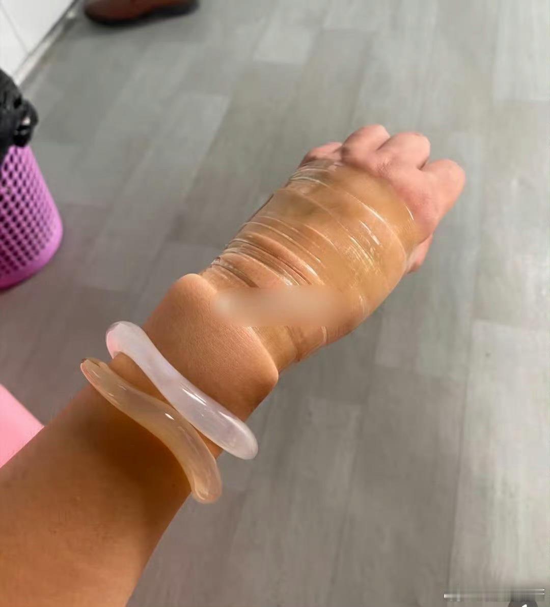 老婆的手镯取不下来了，该怎么办才好？ ​​​