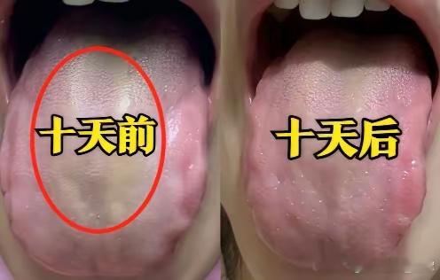 用这个办法，99% 的厚腻苔都能除的一干二净！​直接看舌头：舌苔又白又厚腻，是痰