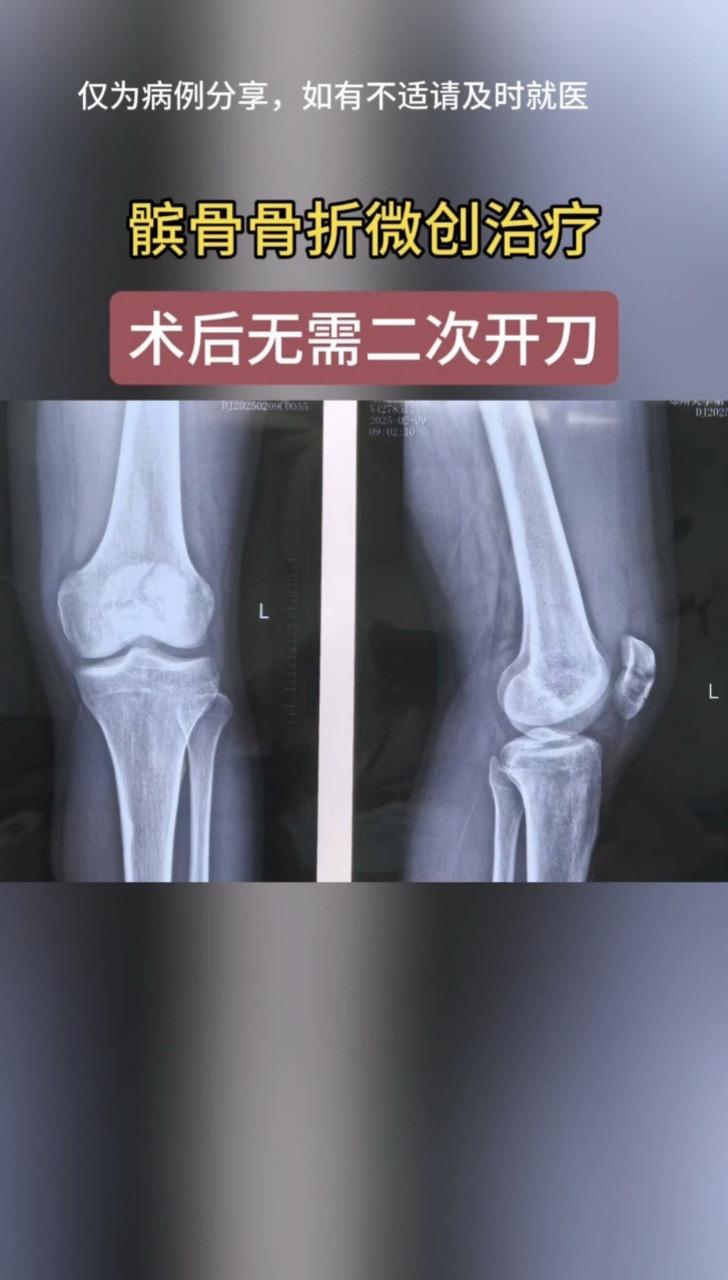 髌骨骨折微创治疗。很多患者以为髌骨骨折手术注定要挨两刀，第一刀放钢针...