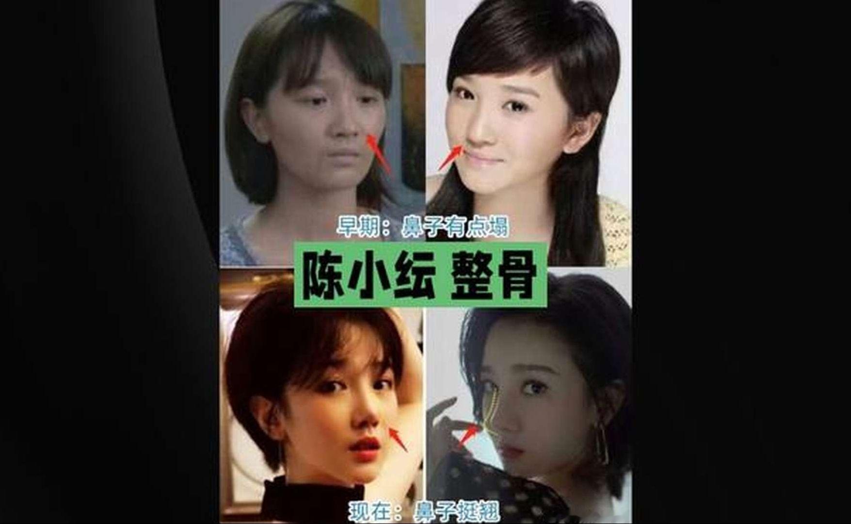 陈小纭近10次整骨边哭做，生图面部状态引热议#陈小纭#