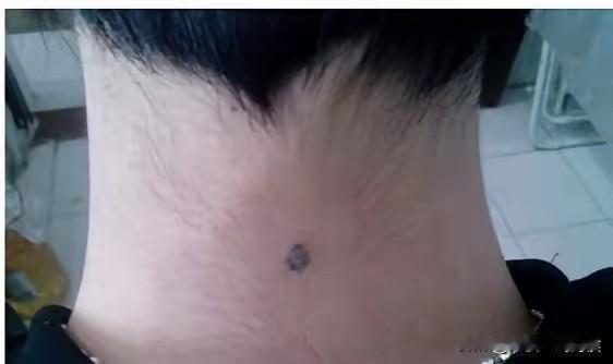 我胳膊上有个胎记，但我今生没有找到类似胎记的人。
小时候是一个五角星形状，奶奶总