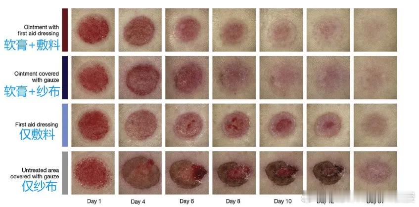 湿性愈合的好处之一：伤口不易留疤。一项在磨蚀性伤口模型对4种治疗方案（软膏+敷料
