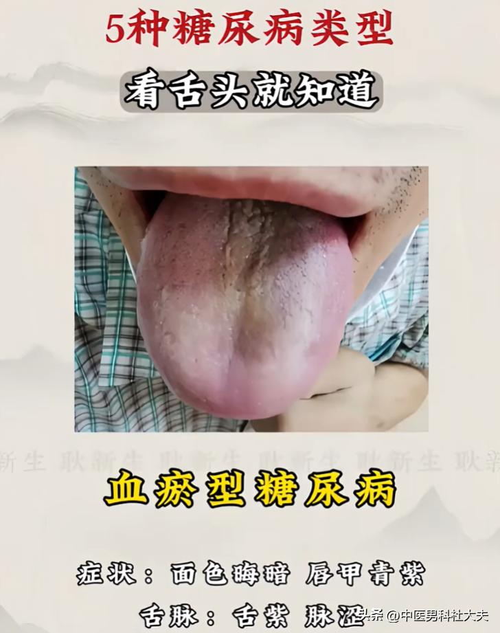 同样血糖高体质不同，五种糖尿病舌诊对照科普