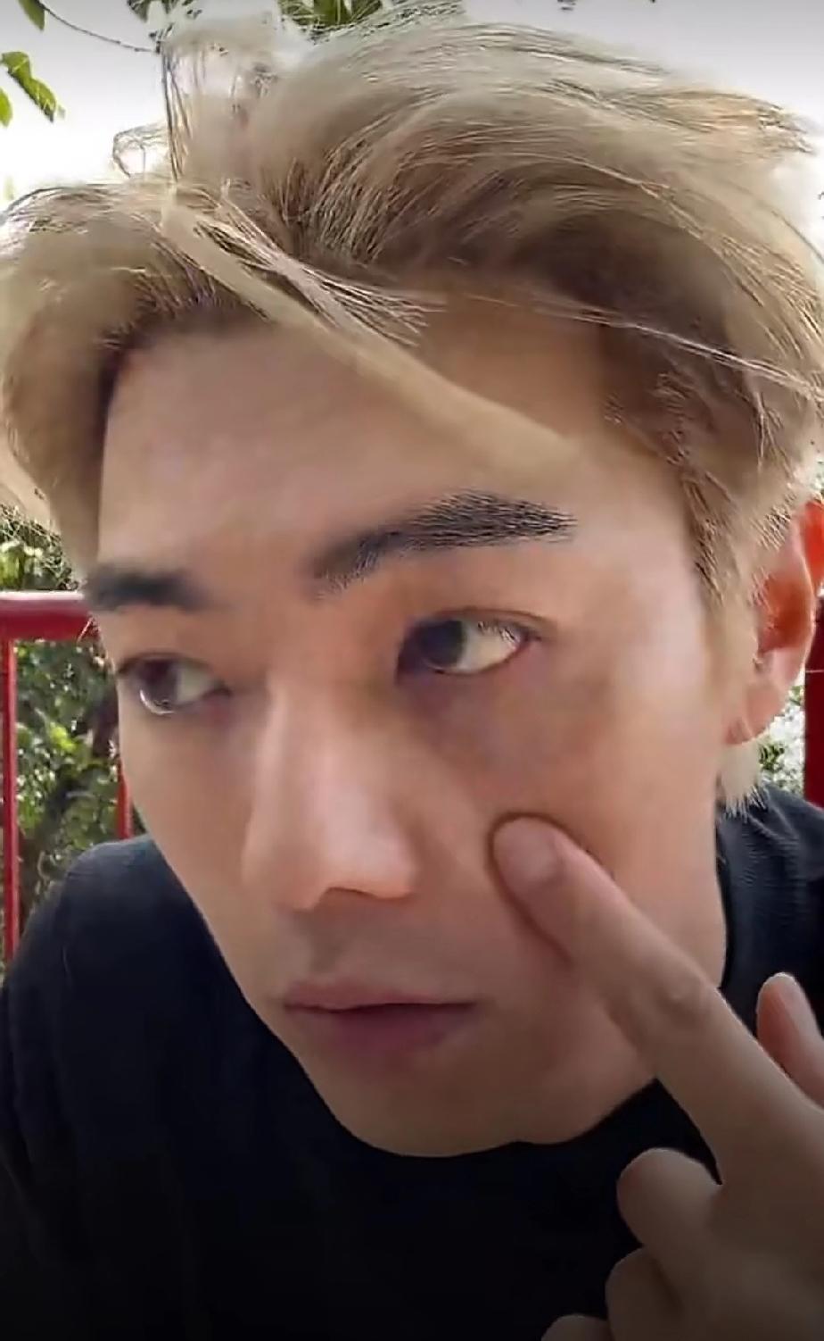 男演员许凯自曝曾在左脸缝了8针，具体是哪一年做的手术他忘了，手术时虽然打了麻醉，