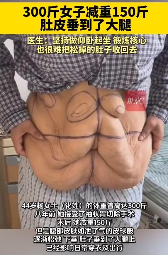 “天塌了！”7月26日报道，江苏，一女子体重高达300斤，为了摆脱肥胖带来的一系