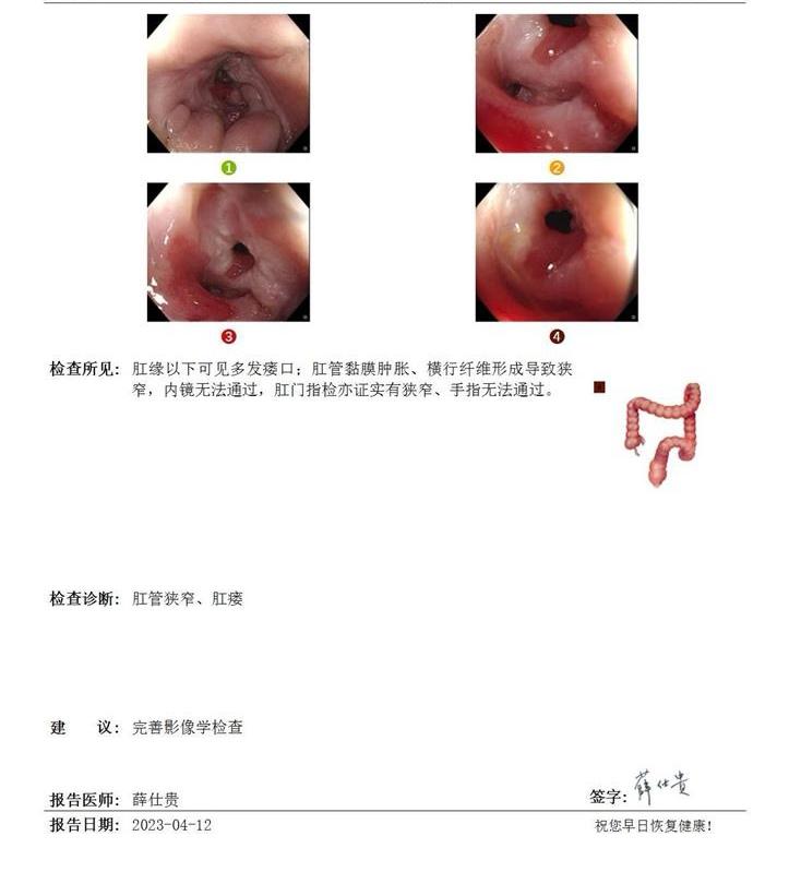 20年的克罗恩病导致直肠肛管狭窄。特别感谢薛主任，加班到下午1年，把20年cd患者直肠纤维环内镜下切开，看到了结肠的全貌。