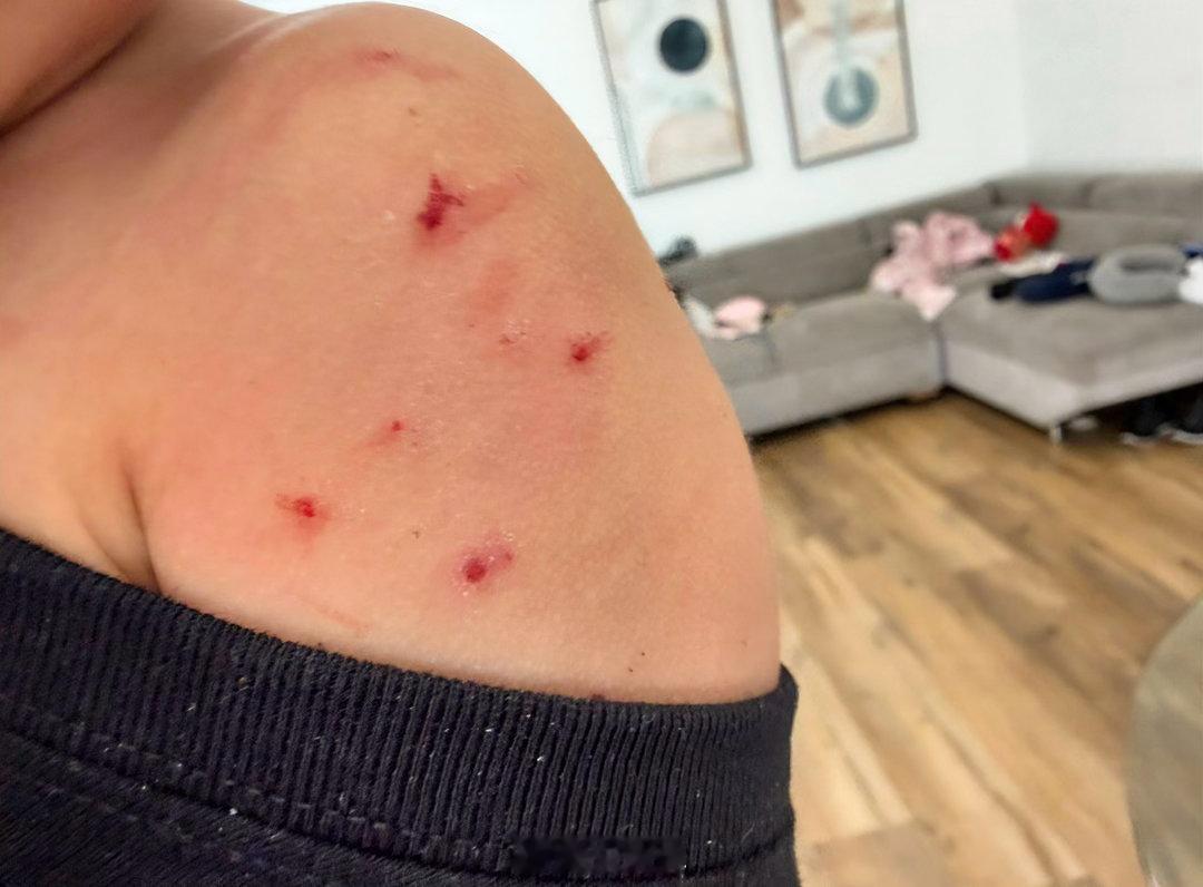 总在记忆里 （1598）：蚊子真毒，把妹妹皮肤咬了好多肿包，然后被她抓烂了。抹了