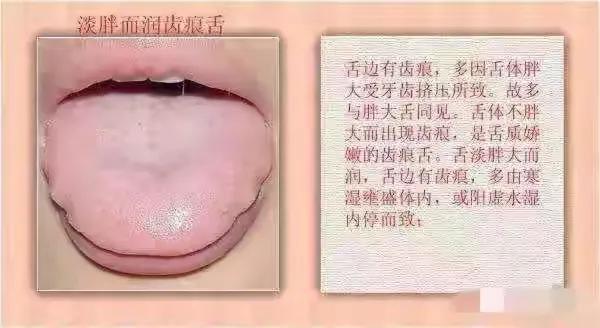 你是否发现自己的舌头边缘有深深的齿痕？这可能是齿痕舌，但别担心，调理方法很简单！