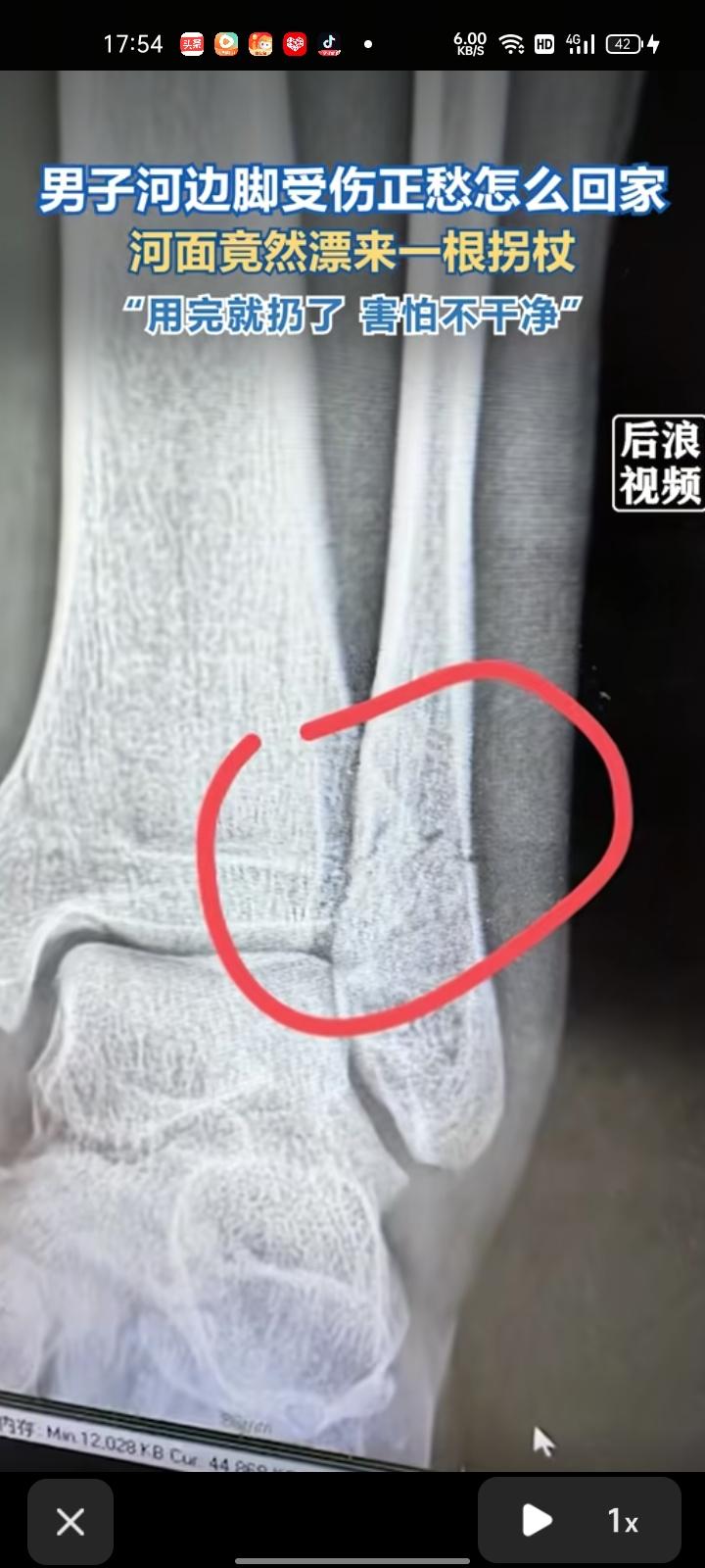 3月11日，四川成都。男子发视频表示，自己在河边被石头砸到脚导致骨折，正愁着怎么