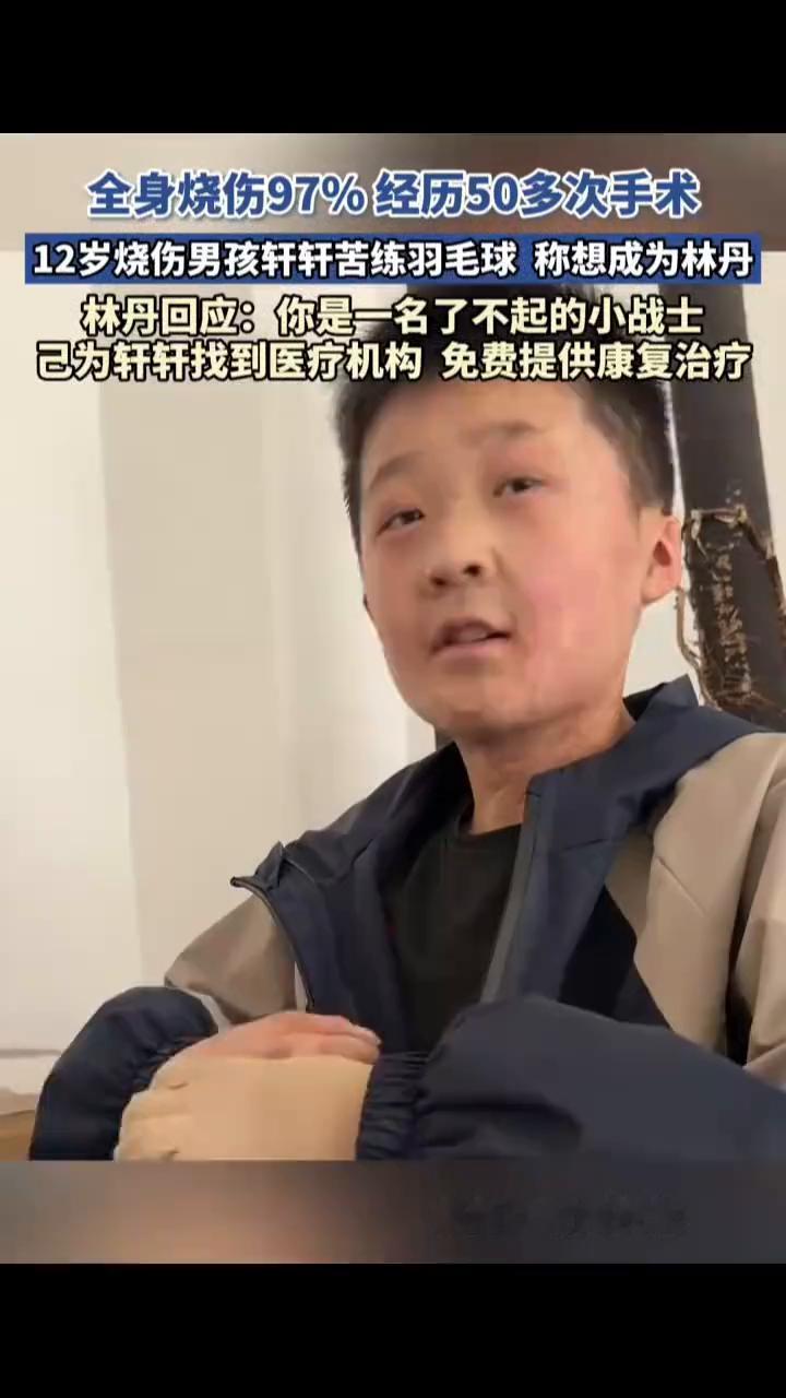 全身烧伤97%，经历50多次手术。12岁烧伤男孩轩轩苦练羽毛球，称想成为林丹。林