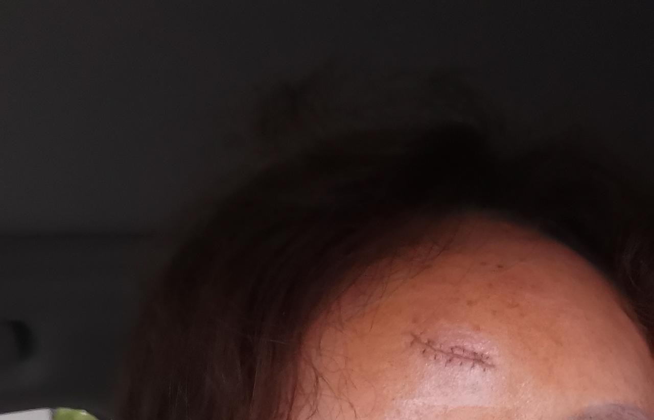 一个跟头，将我一个月的养老金很轻松地就摔没有了！

10天前，晚上下班回家，我依
