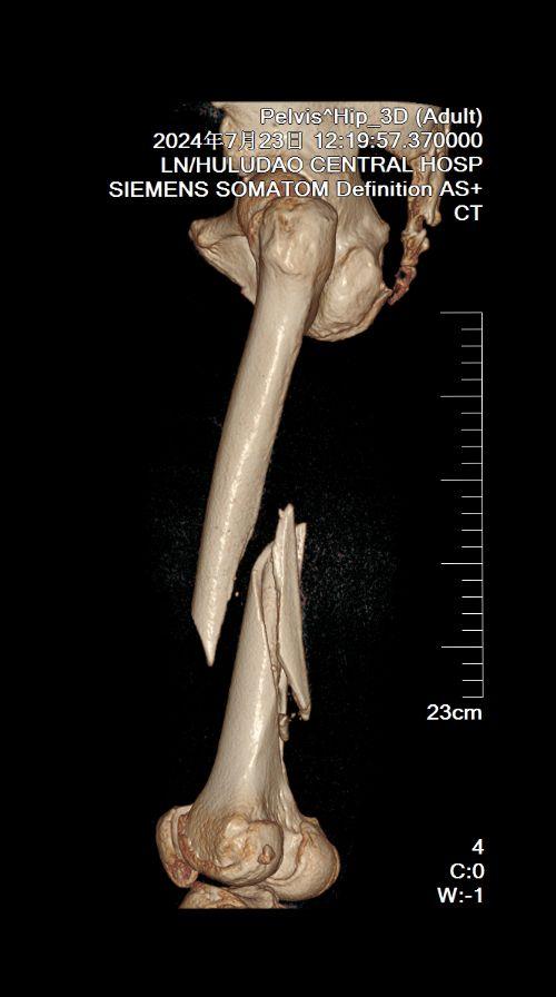 32c-B2型股骨骨折，巨大漂离的楔形骨块，2周的半陈旧状态，为了满足...
