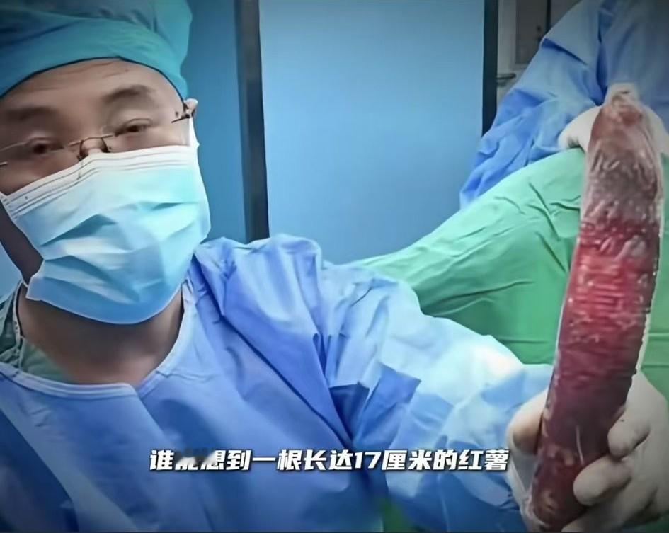 成都肛肠科的大夫也是见多识广，连红薯入体的病例都能遇到！
这位61岁大爷也是够猛