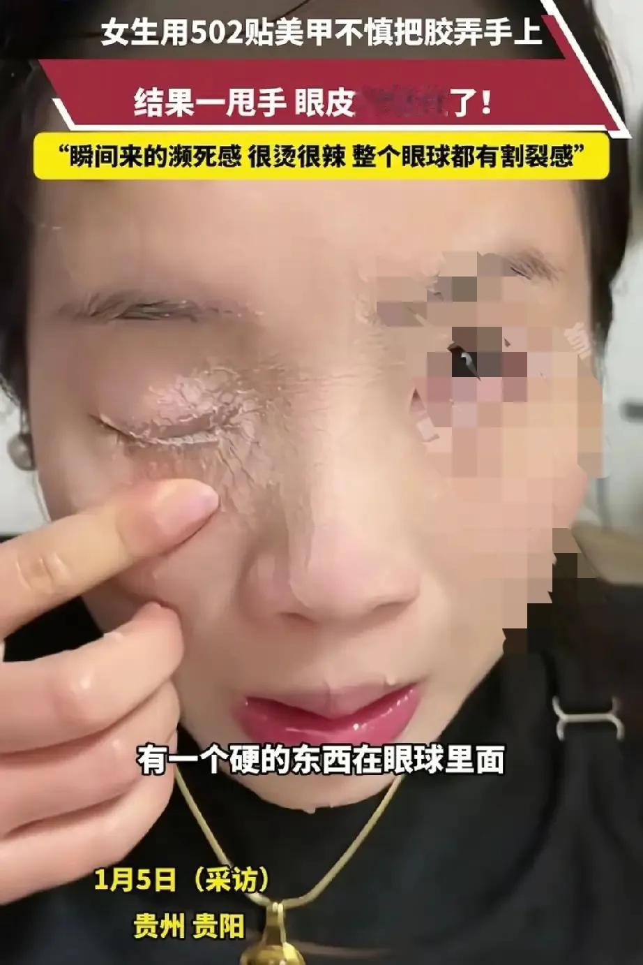 濒死瞬间！贵州贵阳，何女士在家中贴美甲片，谁知手上粘了502胶水，随手一甩刚好甩