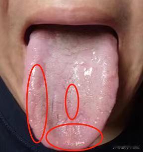 遇到这样的舌头就头疼，房事短、功能差、欲望强，有这三个症状都长点心

今天这位粉