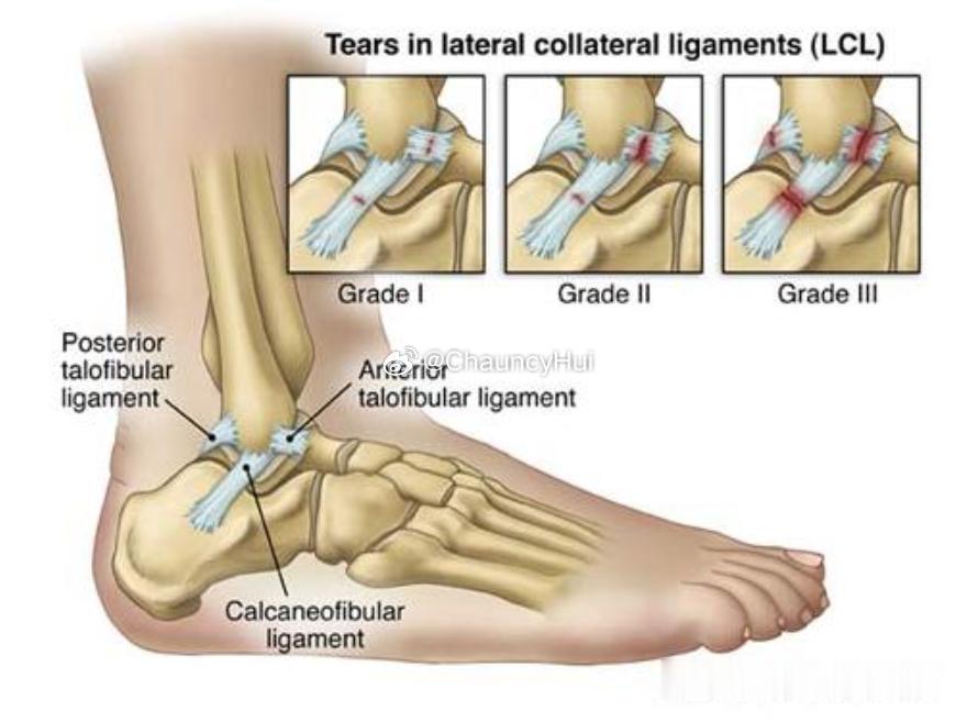 亚当斯脚踝为Ⅲ级扭伤Ⅰ级扭伤（轻度）韧带纤维轻度牵拉并出现显微性撕裂，常累及前距