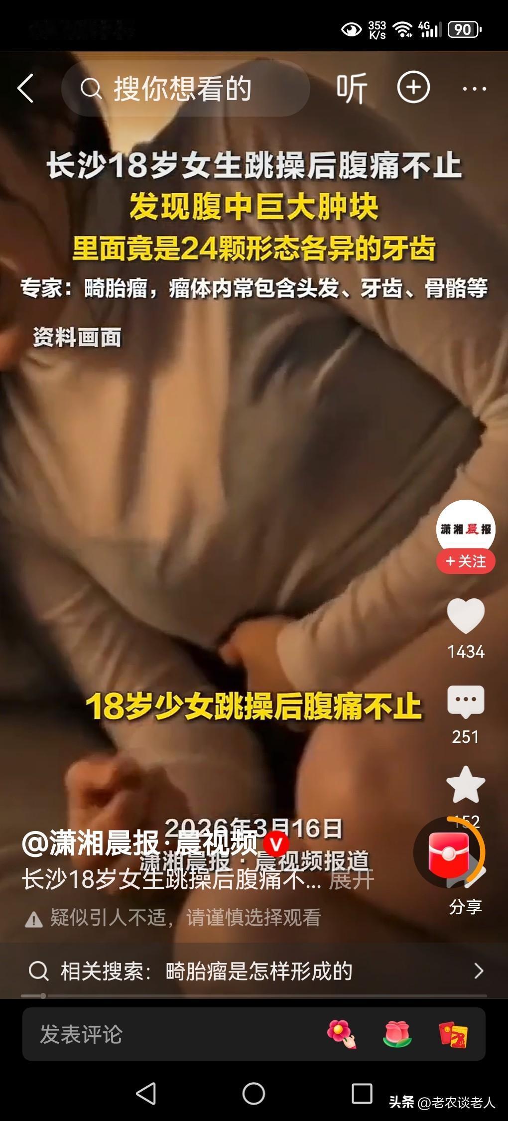 18岁女生腹中肿块里还有24颗牙齿！这是怎么回事？
人身上的疾病无奇不有，千奇古