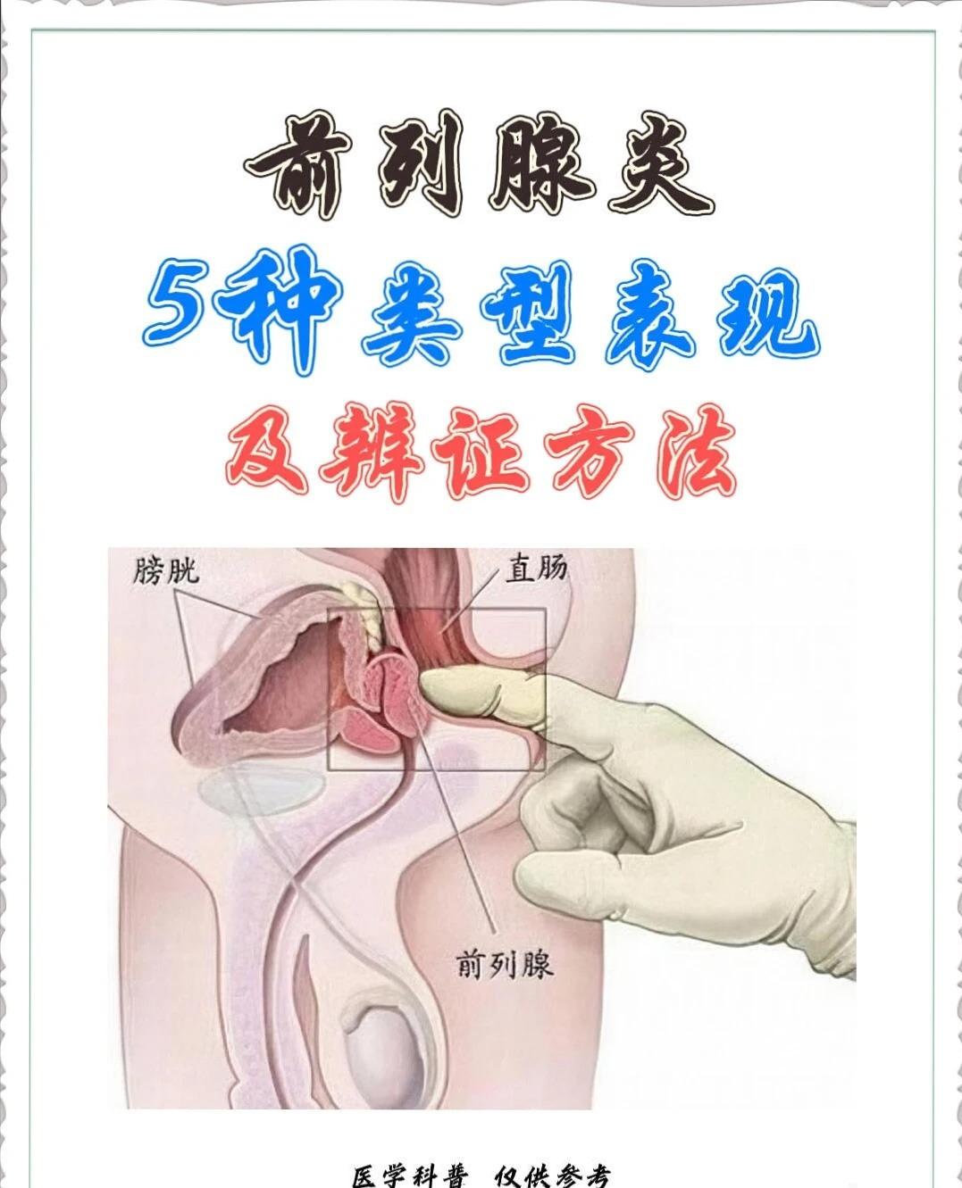 男生私密不适？5种前列腺炎类型自查清单