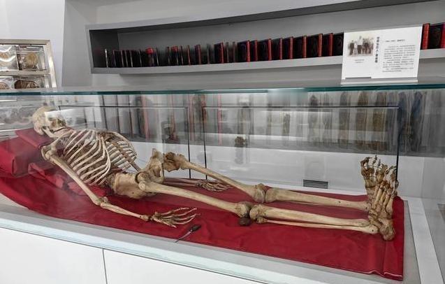 2005年，湖南湘雅医学院的标本室里，放着中国“第一女巨人”曾金莲的遗体，白布包