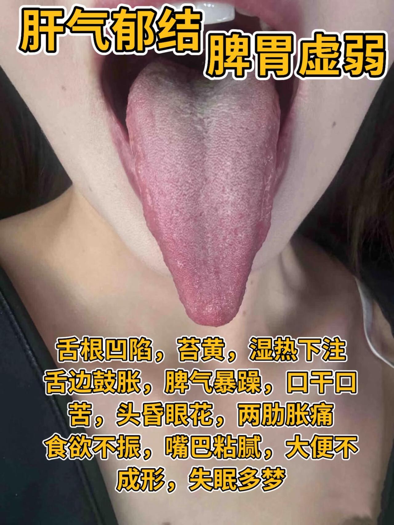 今天有空要给大家诊断舌象 也有人找到武医生 感谢大家相信和支持！
挑几个例子 一
