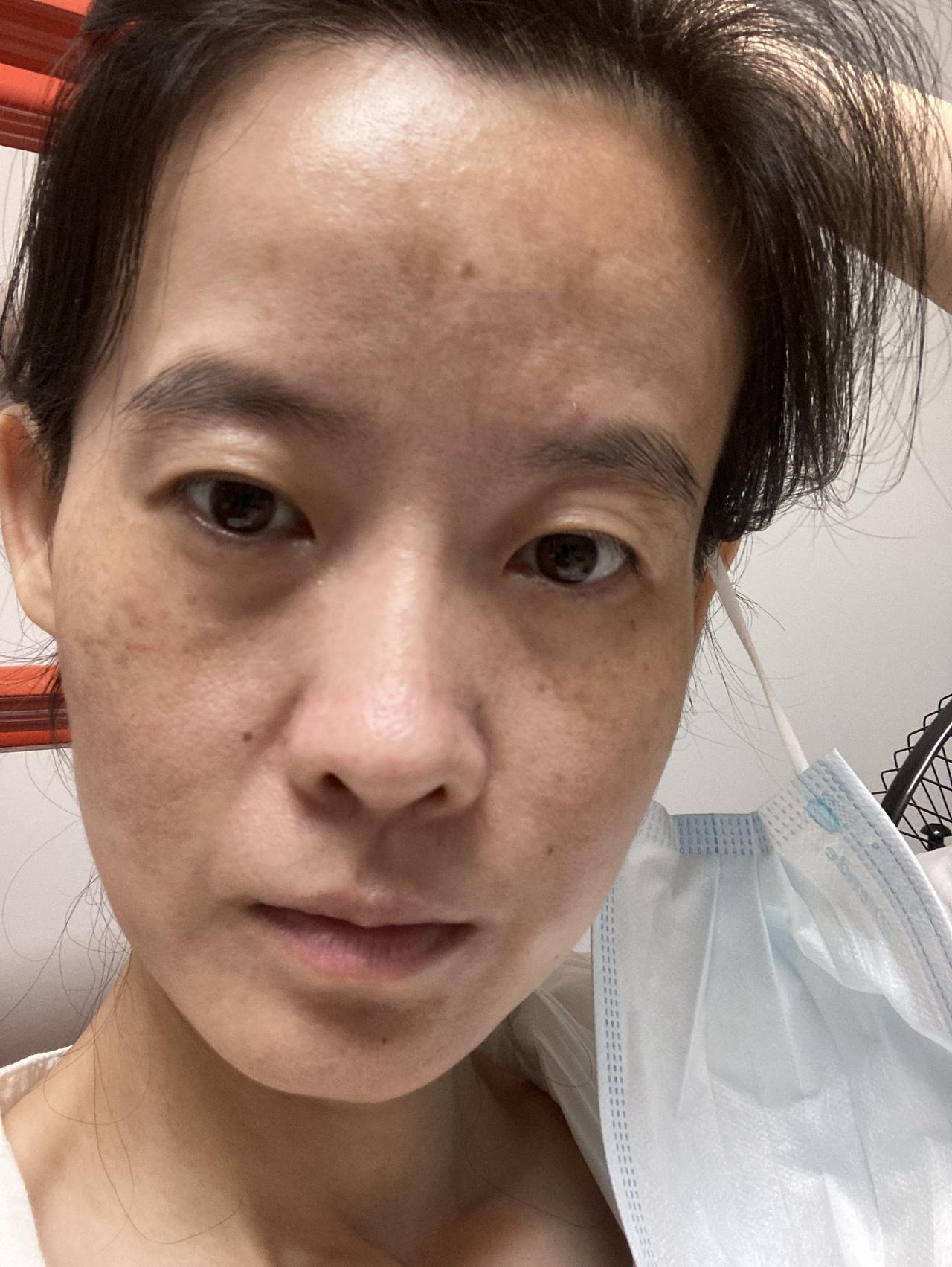 很多人不知道风湿，强直，这样的免疫性疾病会导致内脏疾病以及眼瞎。

这就是所谓的
