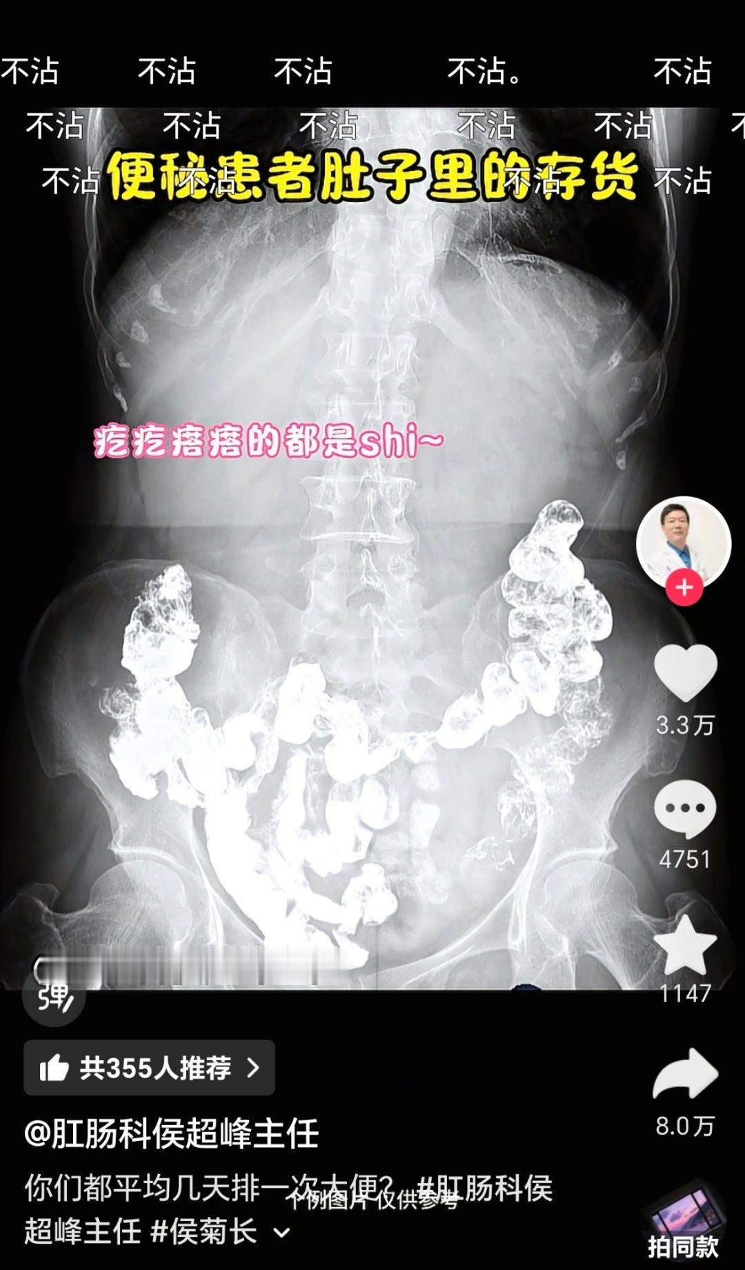 突然想到那句话，人在接吻的时候相当于在吸另一头有💩的吸管 