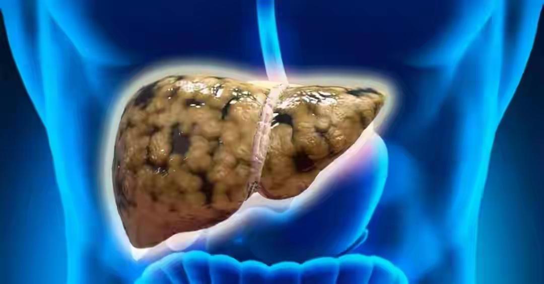 脂肪肝与早餐有关？建议：一旦患上脂肪肝，这5种早餐尽量少吃

内容严格依据《中国