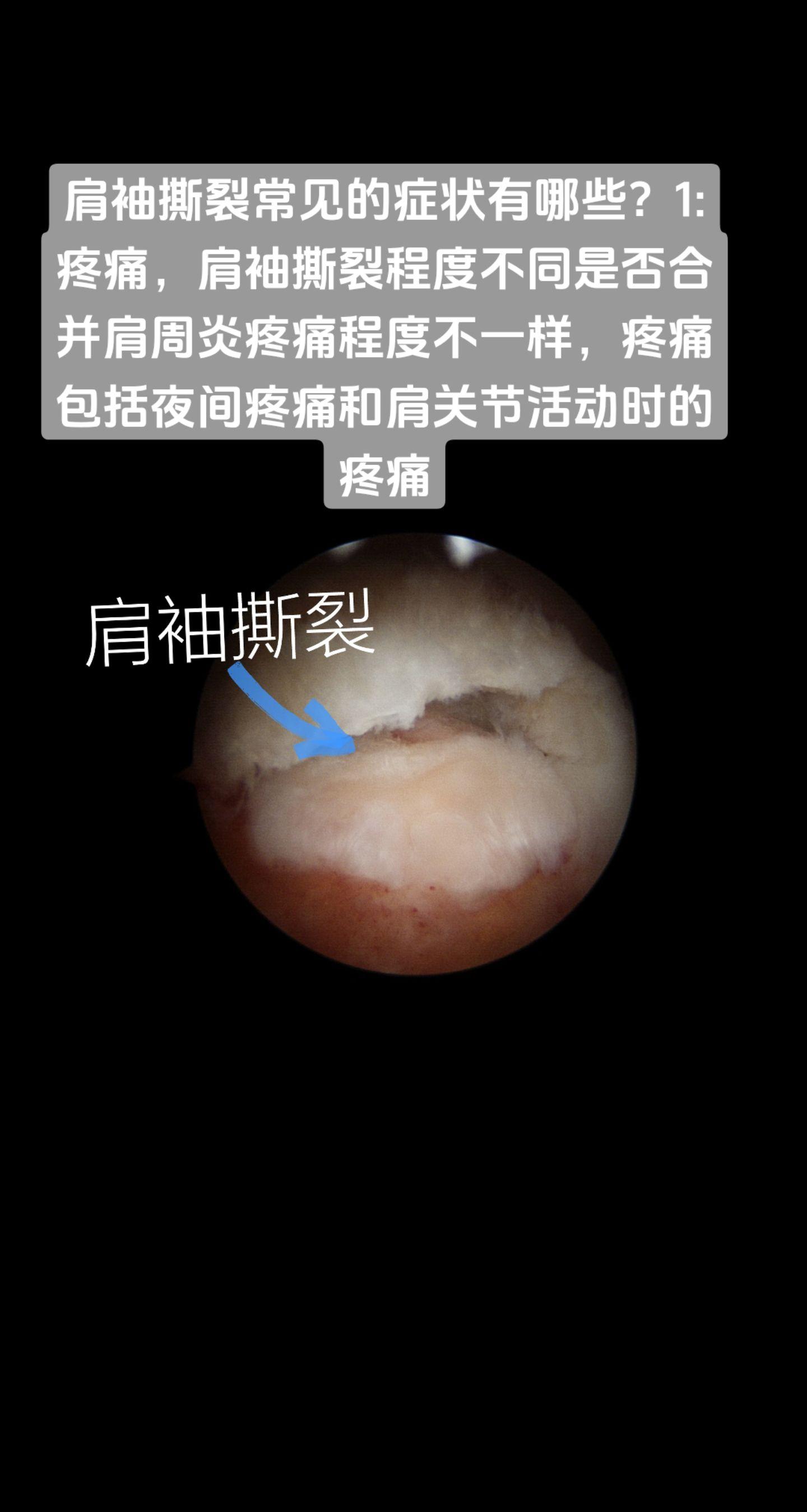 肩袖撕裂常见症状有哪些。