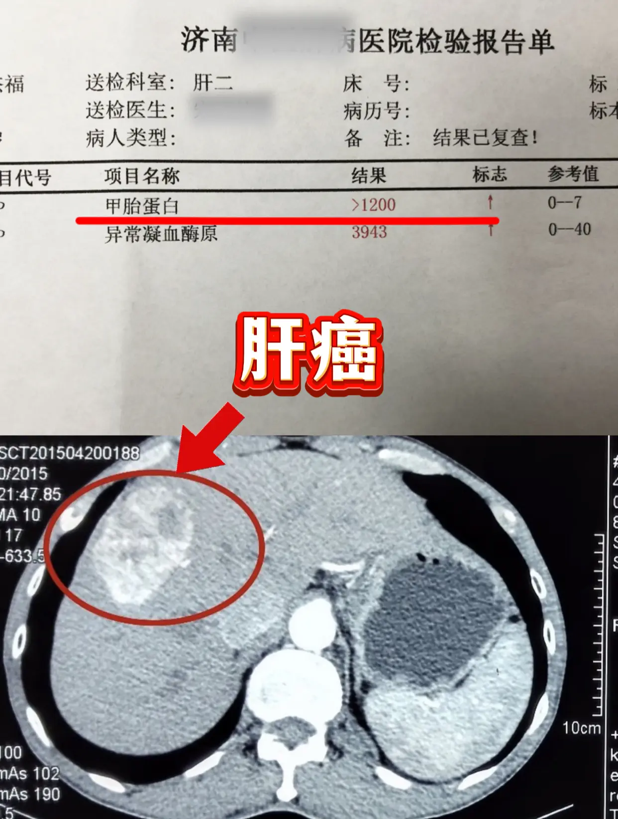 今天又一例，乙肝小三阳没重视导致肝癌。山东青岛的一位粉丝，今年才44岁...