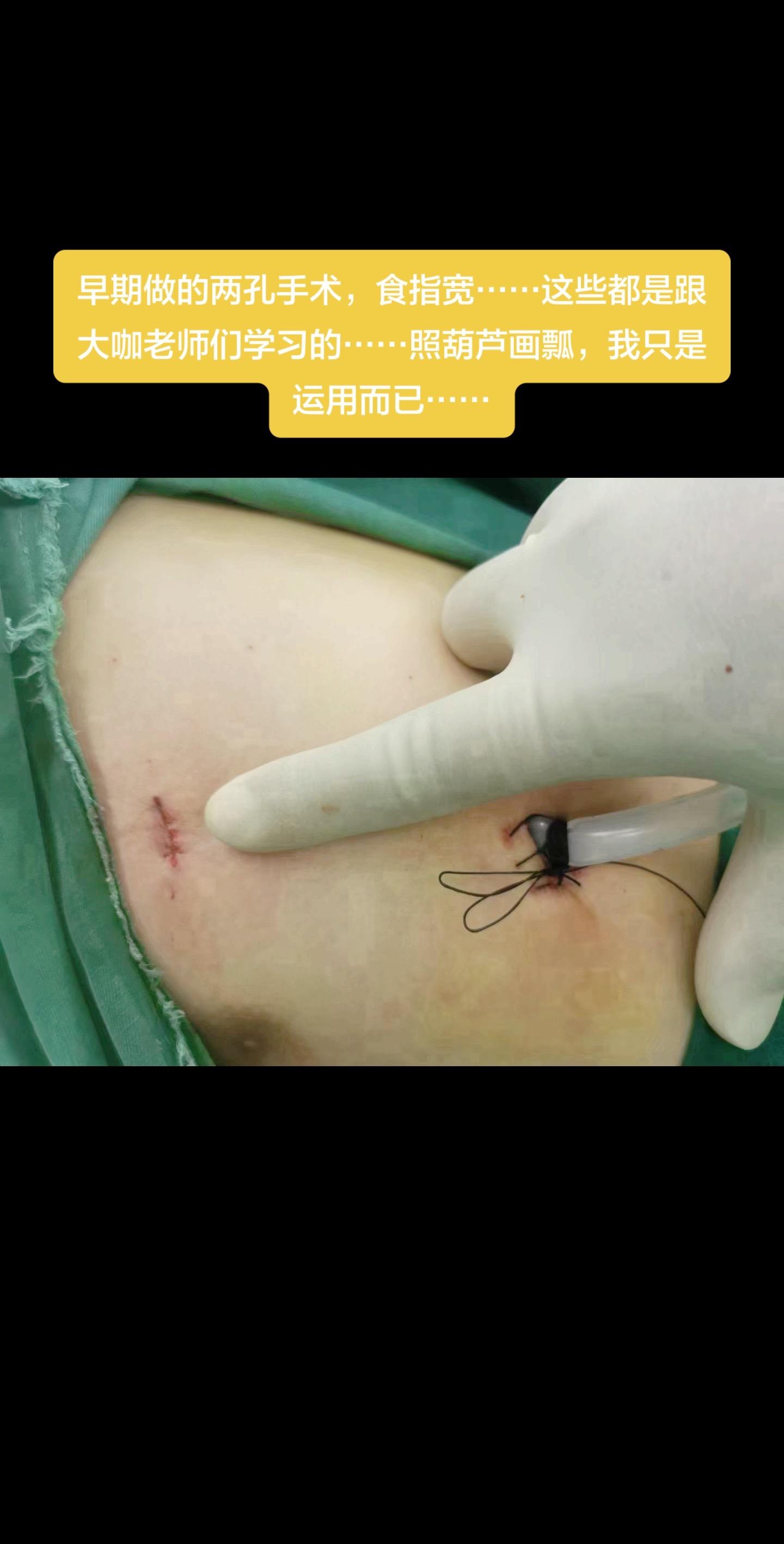 早期做的两孔手术，食指宽……这些都是跟大咖老师们学习的……照葫芦画瓢...