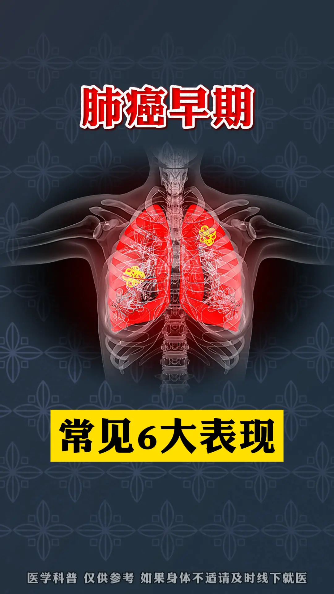 肺癌早期的常见6大表现。