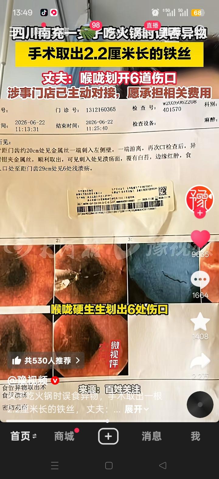 6月22日，四川南充阆中市有一女子吃火锅时吞下2.2厘米的铁丝，光是想想就让人胆