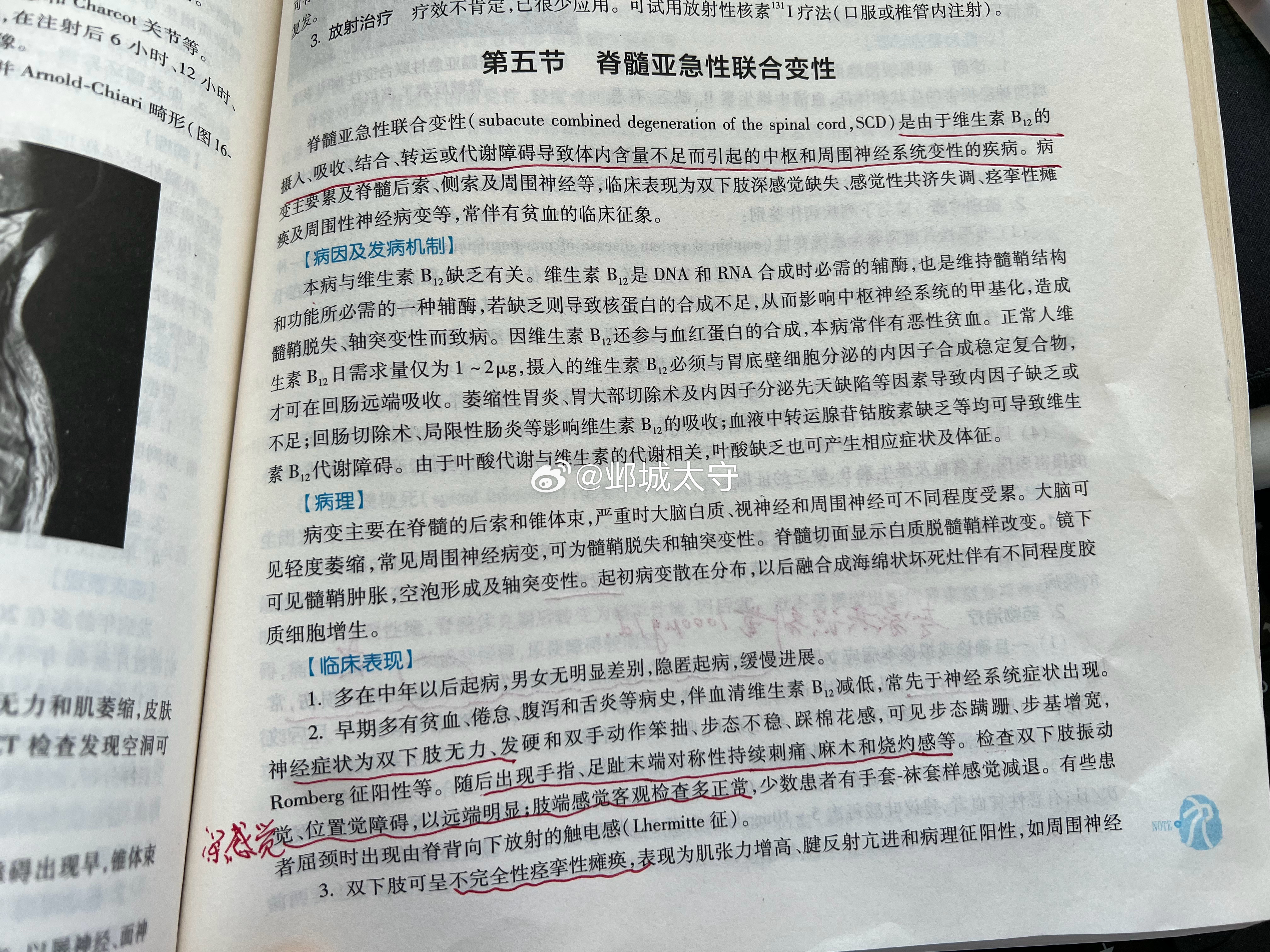 最近又遇到这样一例患者：患者两天前突发双下肢无力，踩棉花感，双脚烧灼感，以至于整