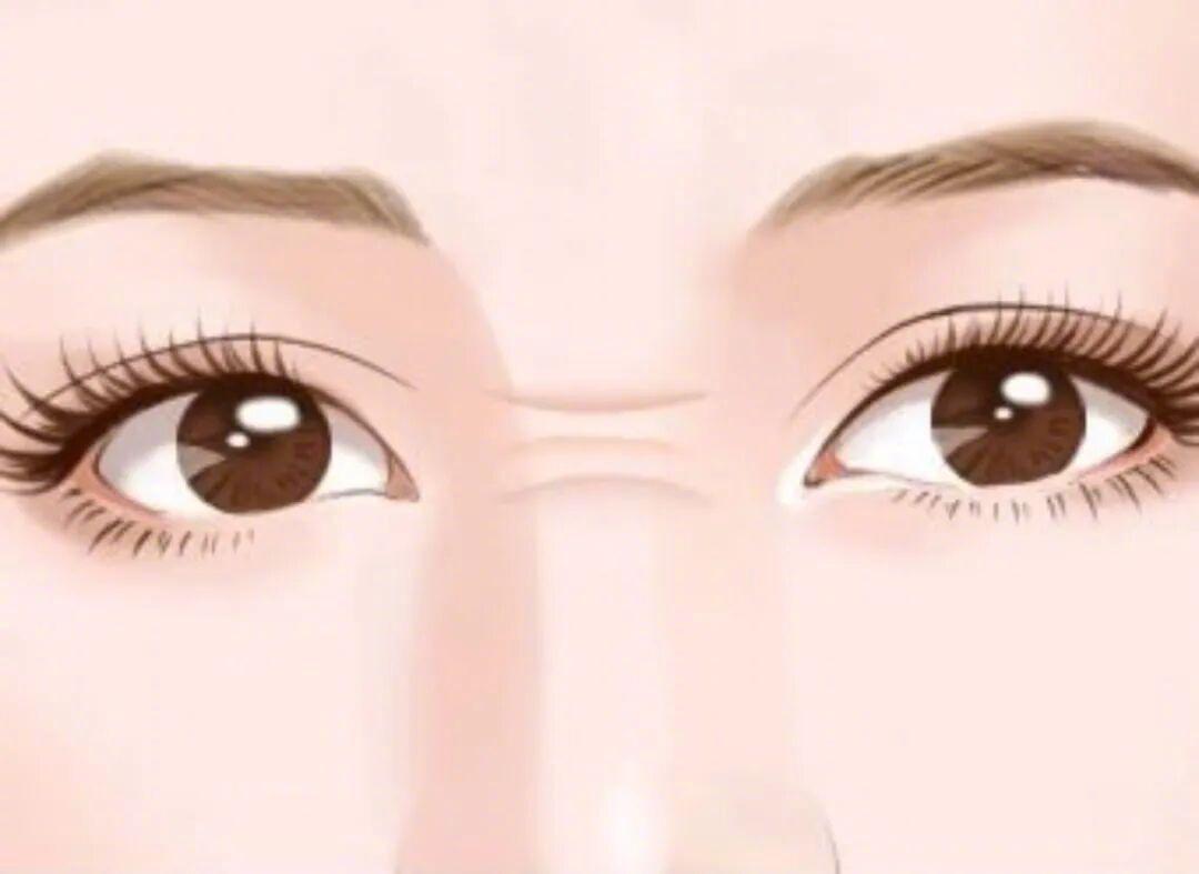 警惕！鼻梁横纹可能是心血管预警信号
 
鼻梁根部出现的横向纹路，被称为“鼻褶心征