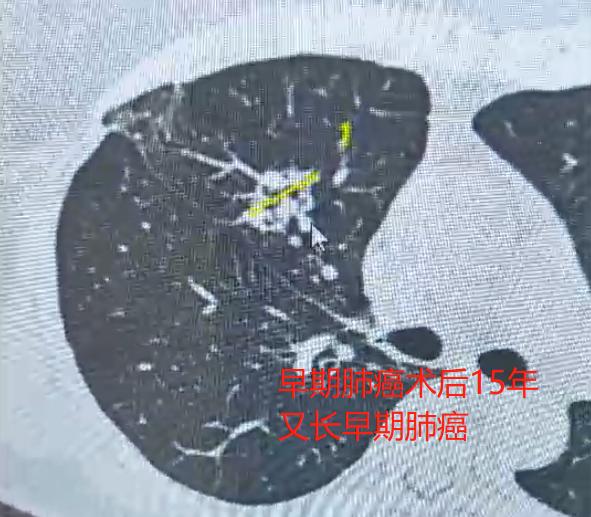肺癌患者熬过5年就安全了吗？一位术后满6年的患者来复查时问我："乔医生，我已经过