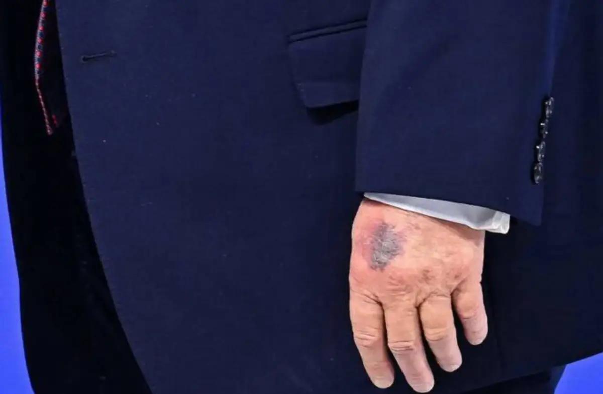 特朗普手有淤青再引健康争议 最近特朗普手上淤青这事又闹得沸沸扬扬。1月1日他就回