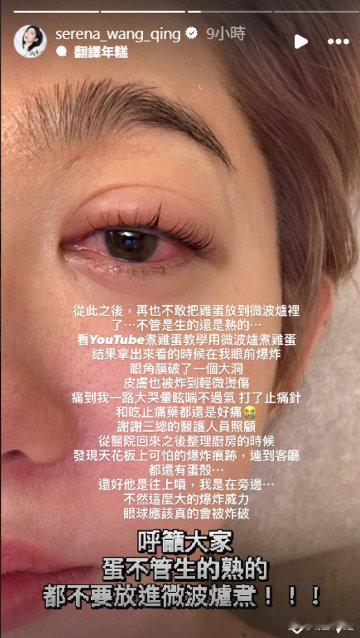 女演员微波炉煮蛋被炸伤眼睛 19日，台湾女演员王晴在ins上晒出左眼红肿的照片，