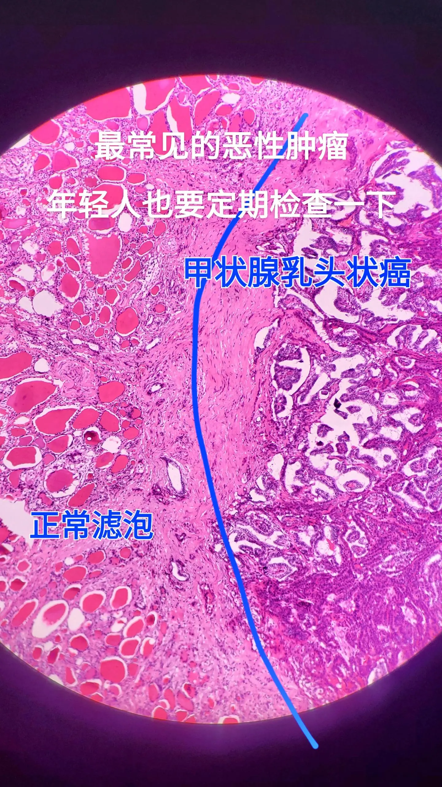 甲状腺乳头状癌