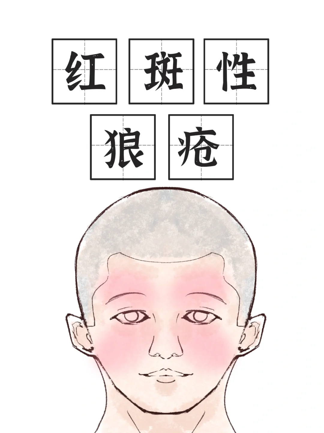 红斑性狼疮-症状/治疗/下针手法