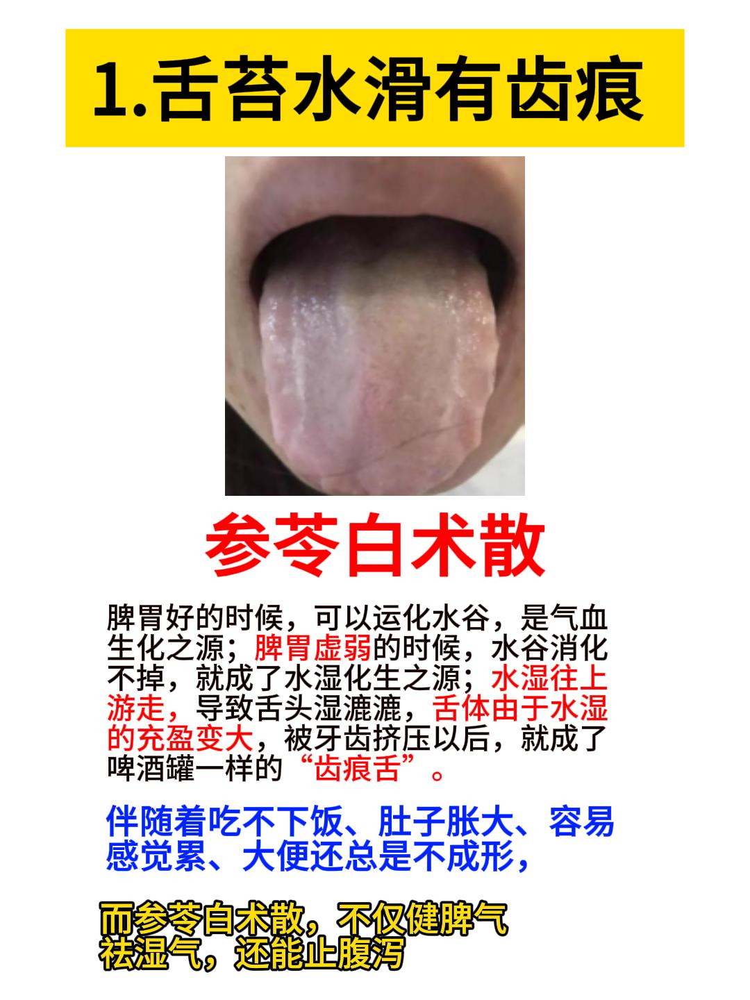参苓白术散，二陈丸，二妙丸，到底应该怎么选？看看舌头就知道！[给力][给力][给